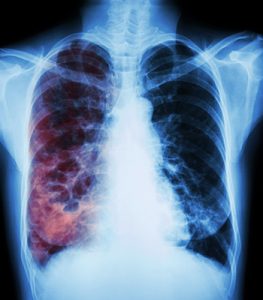 bronchiectasis